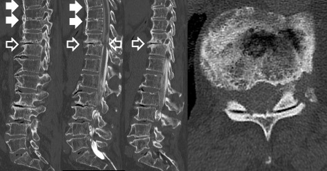 diptic diffuse idiopathic diptic diffuse idiopathic