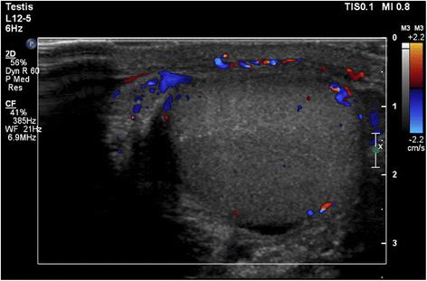 paracetamol journal report  a  Journal testicular infarction: case Segmental