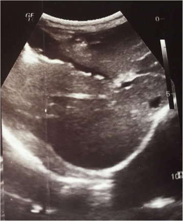 Gallbladder ascariasis in Kosovo – focus on ultrasound and conservative