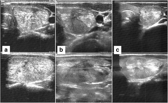 Benign Thyroid Nodule Unresponsive To Radiofrequency Ablation Treated ...