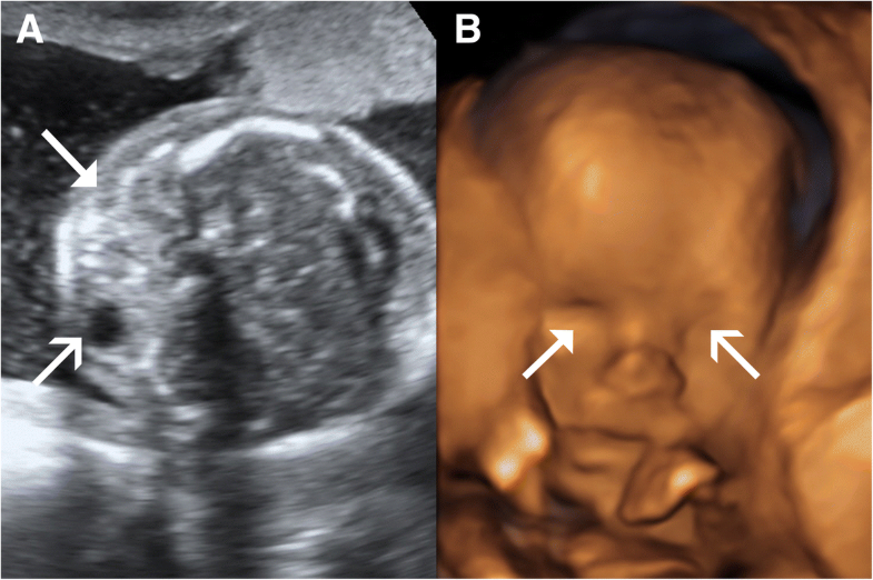 Prenatal diagnosis and implications of microphthalmia and anophthalmia