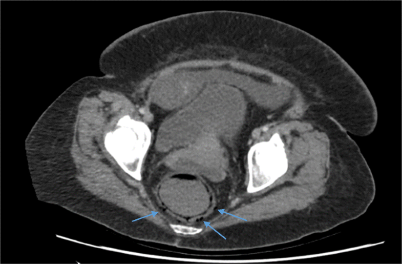 Rectal perforation following paclitaxel and carboplatin chemotherapy