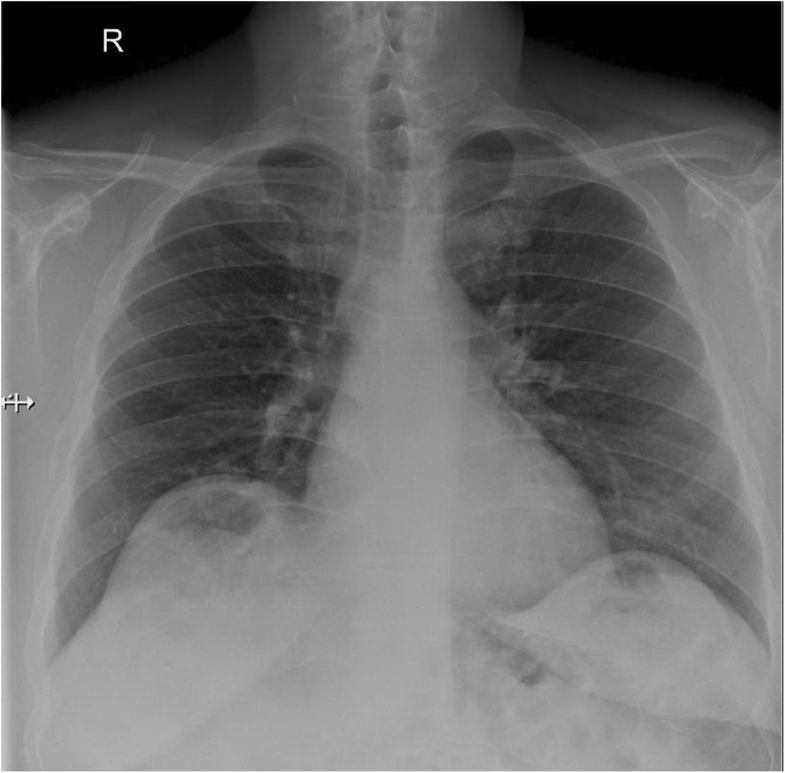 Chilaiditi syndrome – a rare case of pneumoperitoneum in the emergency ...