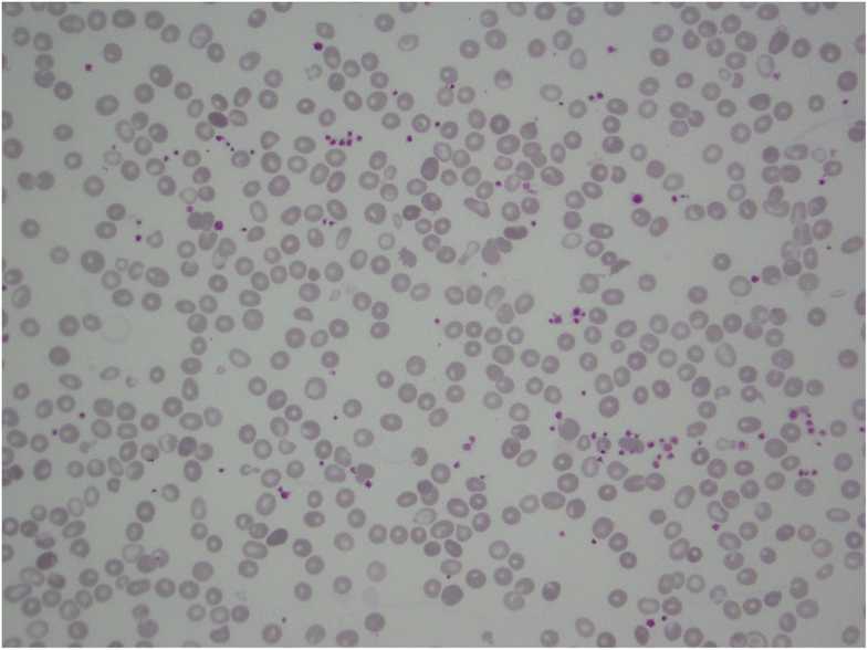 Vitamin B12 deficiencyinduced pseudothrombotic microangiopathy without