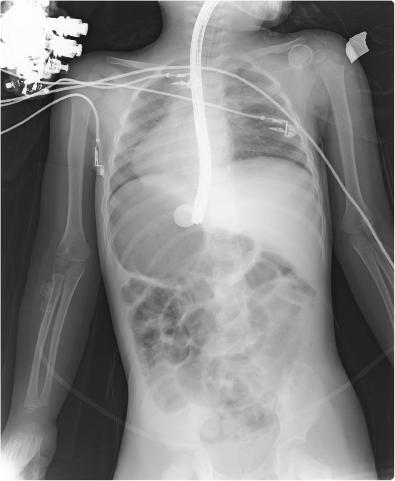 Button battery removed from the stomach resulting in a missed