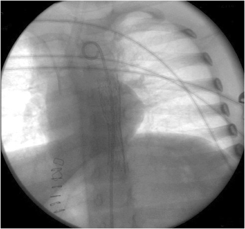 Button battery removed from the stomach resulting in a missed