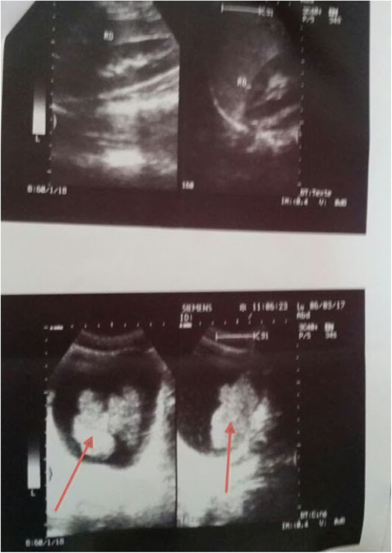 A rare pure embryonal rhabdomyosarcoma of the urinary bladder in an