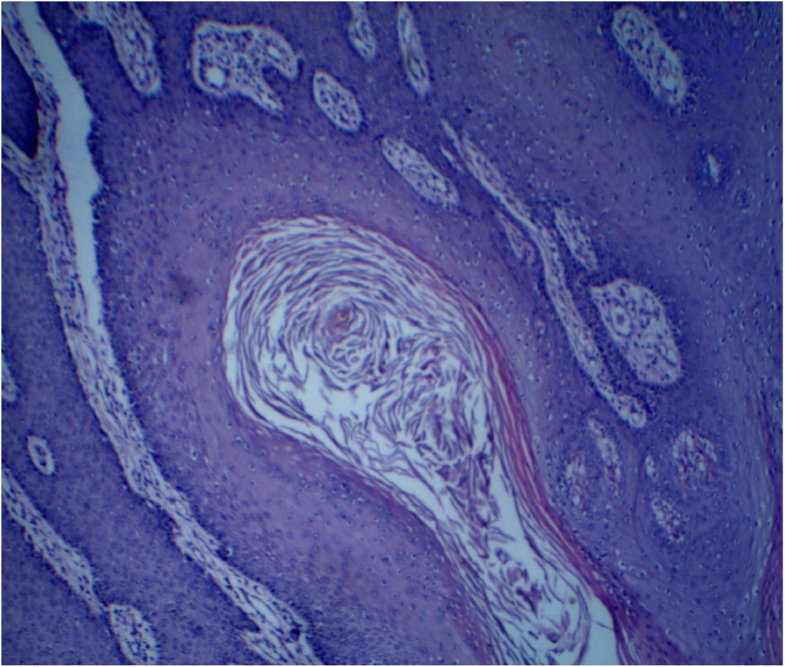 Paiful cyst by my clitoris Paiful cyst by my clitoris