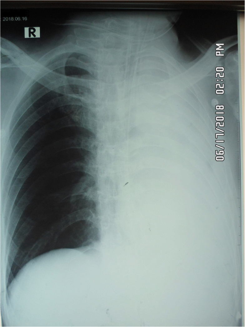 Fig. 1 Chest X-ray anteroposterior view showing complete left lung collapse and hyperinflated right lung with right-sided subcutaneous emphysema