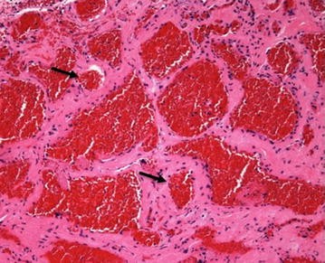 vascular loop internal auditory canal treatment vascular loop internal auditory canal treatment