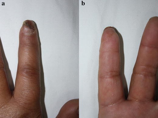 Fingertip Replantation Zone I Without Venous Anastomosis Clinical