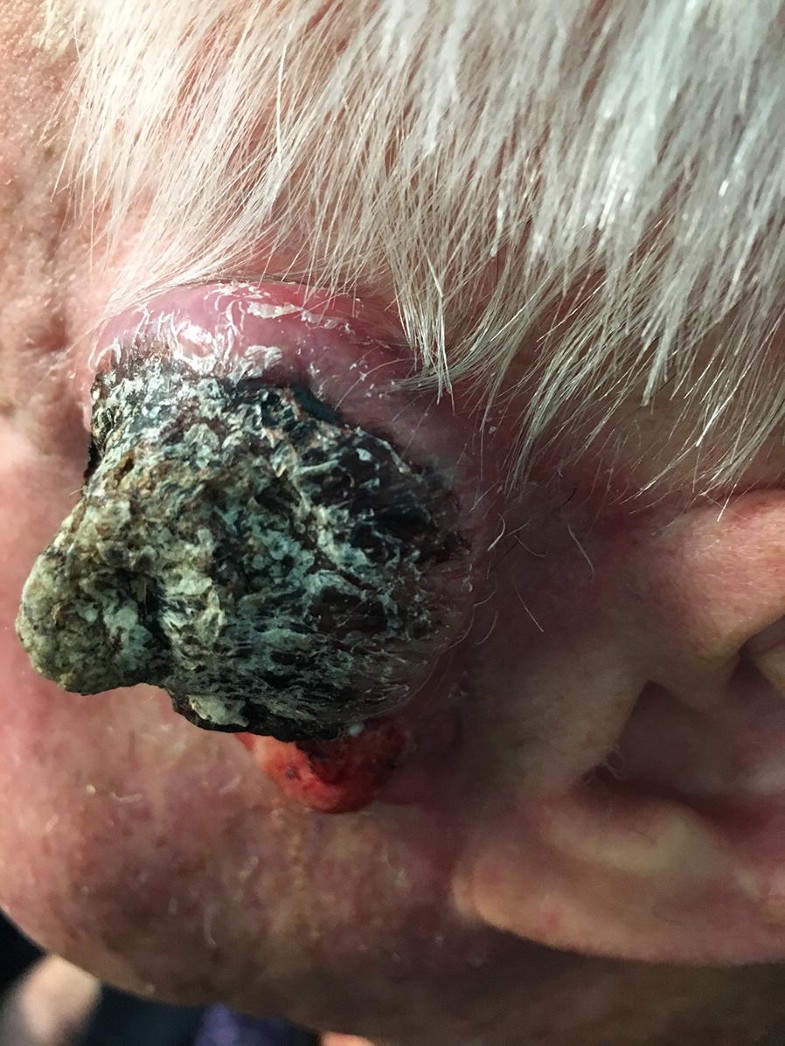 Metastatic squamous cell carcinoma of the skin with