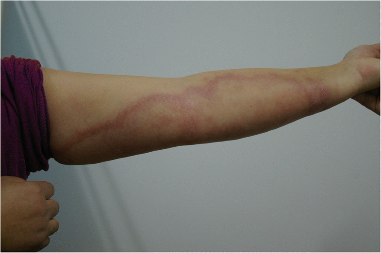 A rare case of type 1 leprosy reactions following tetanus infection in
