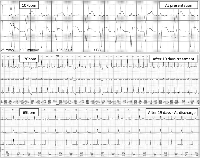 Acute heart failure due to autoimmune myocarditis under pembrolizumab ...