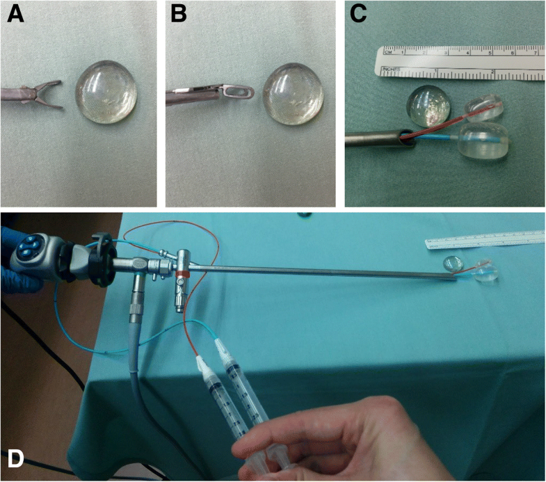 Double Fogarty balloon catheter technique for difficult to retrieve