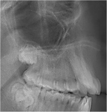 Influence of maxillary posterior dentoalveolar discrepancy on ...