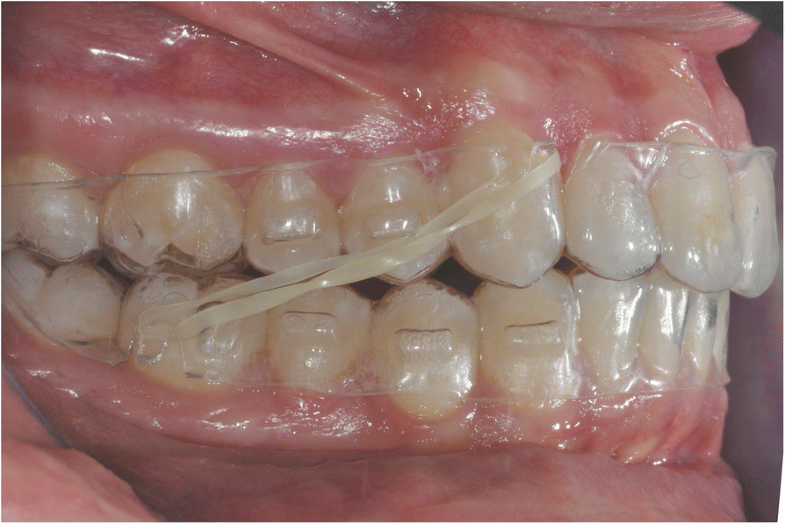 Class II subdivision correction with clear aligners using intermaxilary