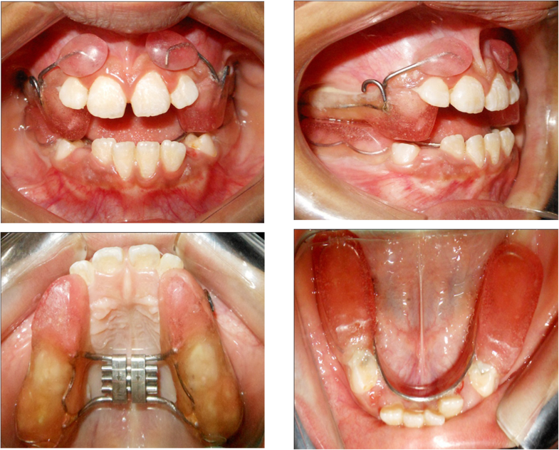 Effectiveness of reverse twin block with lip padsRME and face mask