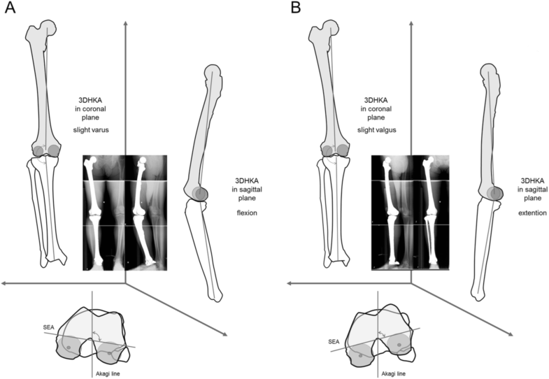 Contribution Of Sex And Body Constitution To Three Dimensional Lower Extremity Alignment For