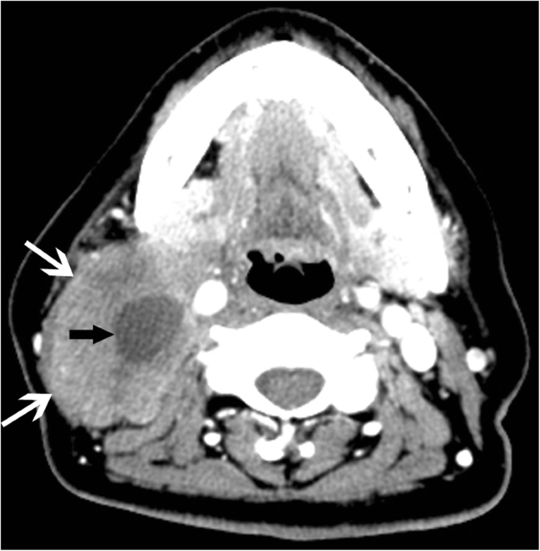 Castleman Disease Versus Lymphoma In Neck Lymph Nodes A Comparative