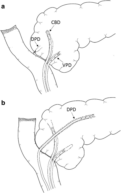Acute obstructive pancreatitis after pancreas-sparing total