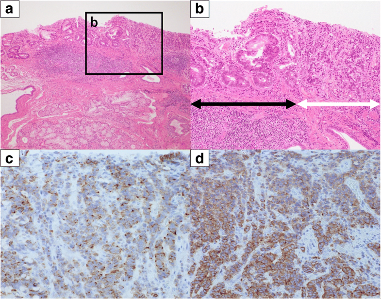 A neuroendocrine carcinoma with a welldifferentiated adenocarcinoma