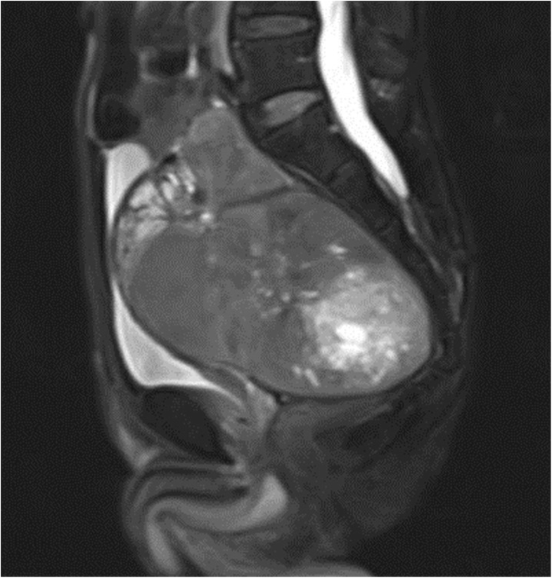 A solitary fibrous tumor in the pelvic cavity of a patient with Doege
