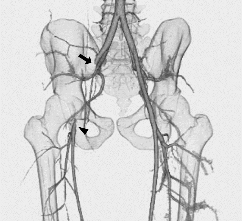 Traumatic right common femoral artery occlusion caused by blunt bicycle handlebar injury a case