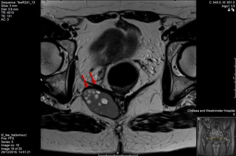An unusual rectal duplication cyst Surgical Case Reports Full Text