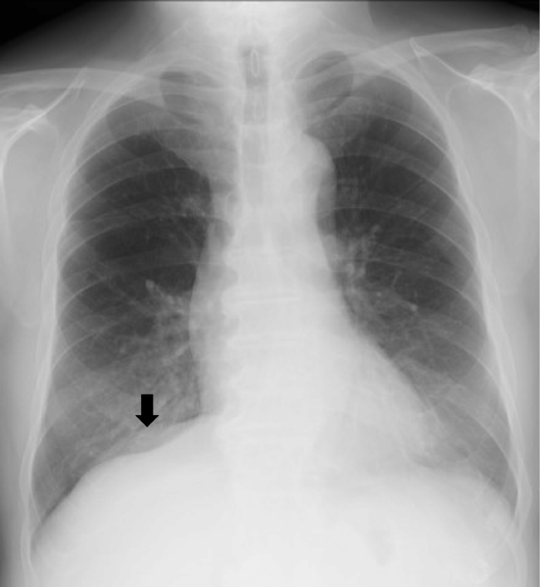 right-sided-bochdalek-hernia-containing-retroperitoneal-fat-in-the