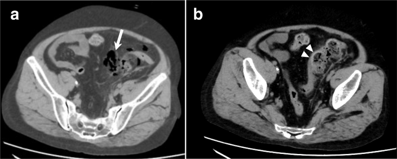 Sigmoid colon perforation in the patient with granulomatosis with ...