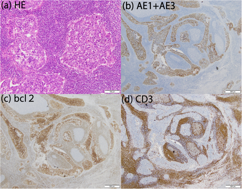 Total thymectomy for thymic lymphoepitheliomalike carcinoma—report of