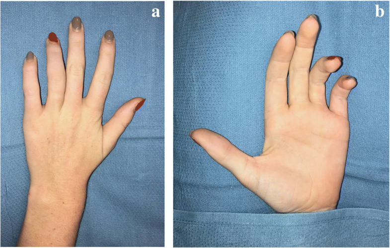 Peripheral nerve injury with Nexplanon removal case report and review