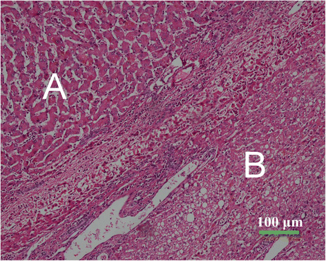 Hepatocellular adenoma with malignant transformation in male patients ...