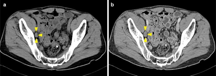 Computed tomography and magnetic resonance imaging evaluation of pelvic