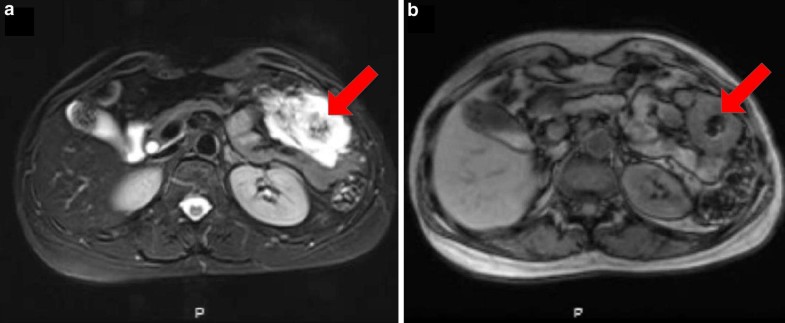 Mucinous colorectal adenocarcinoma: clinical pathology and treatment