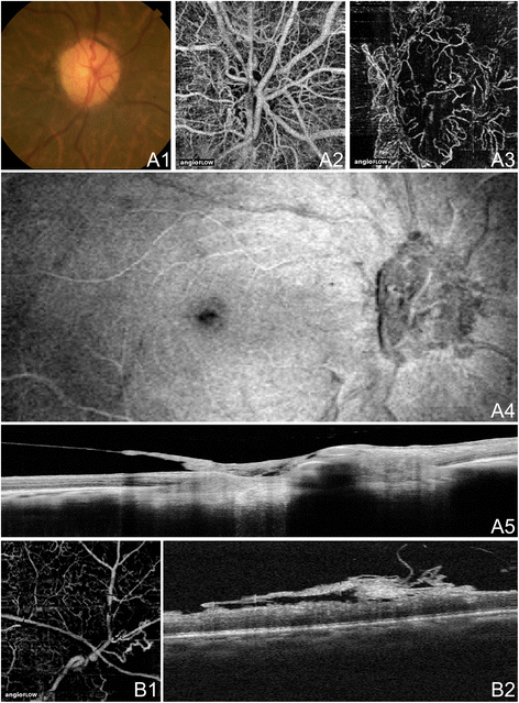 A Review Of Optical Coherence Tomography Angiography (OCTA ...