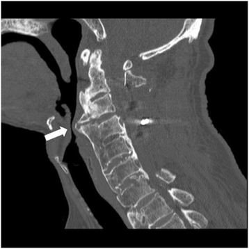 Airway management for patients with ossification of the anterior ...