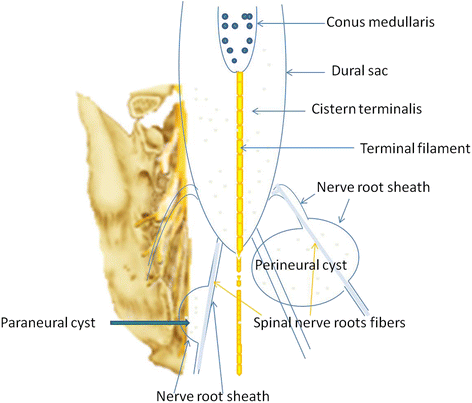 Classification, mechanism and surgical treatments for spinal canal ...