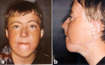 Color Atlas Of Burn Reconstructive Surgery