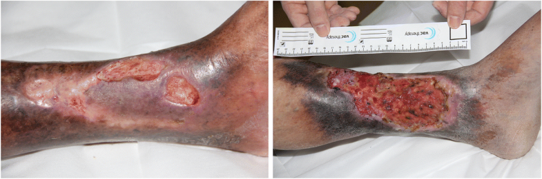 The venous ulcer continues to be a clinical challenge: an ...