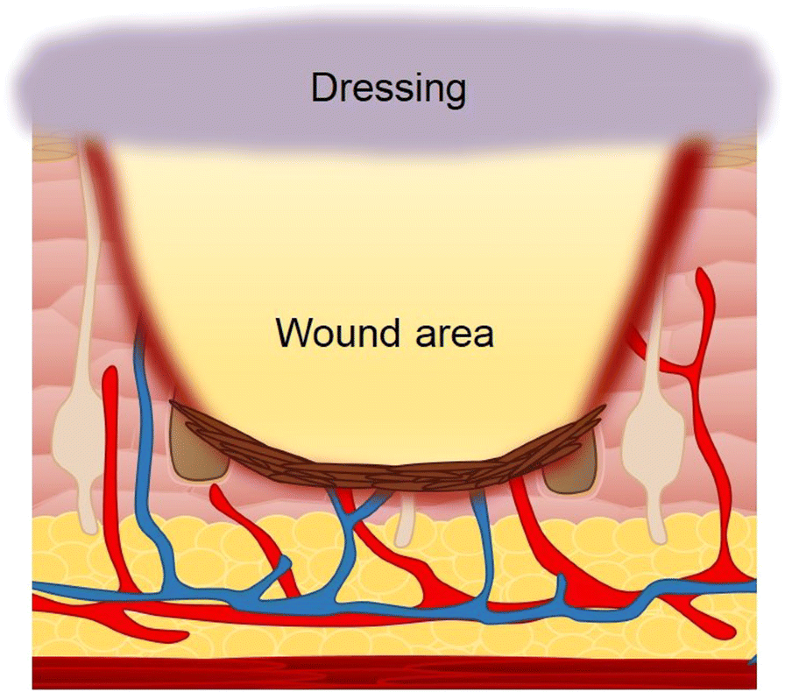 Development and use of biomaterials as wound healing therapies Burns