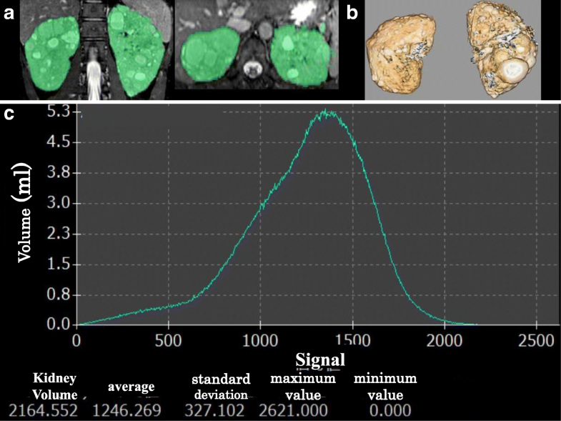 resonance imaging is effective for evaluating the therapeutic