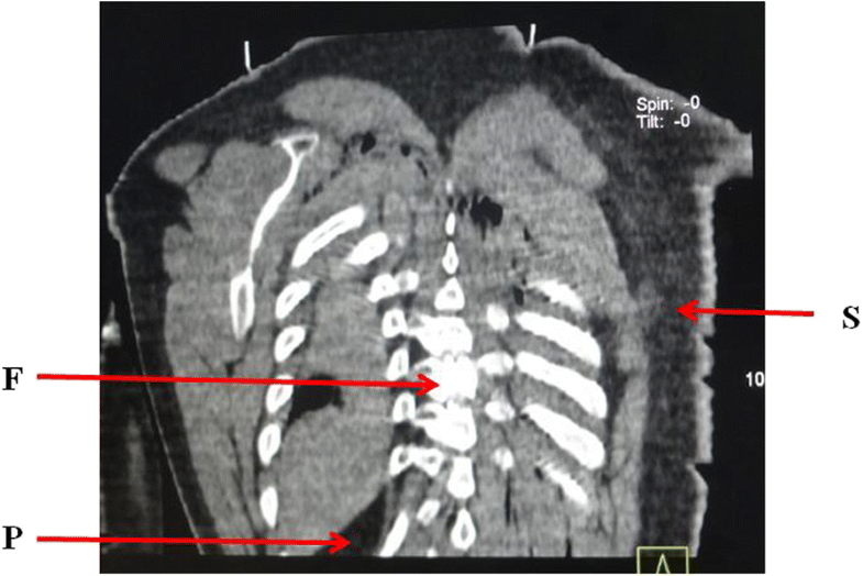 Postmortem computed tomography and autopsy for detection of lesions and