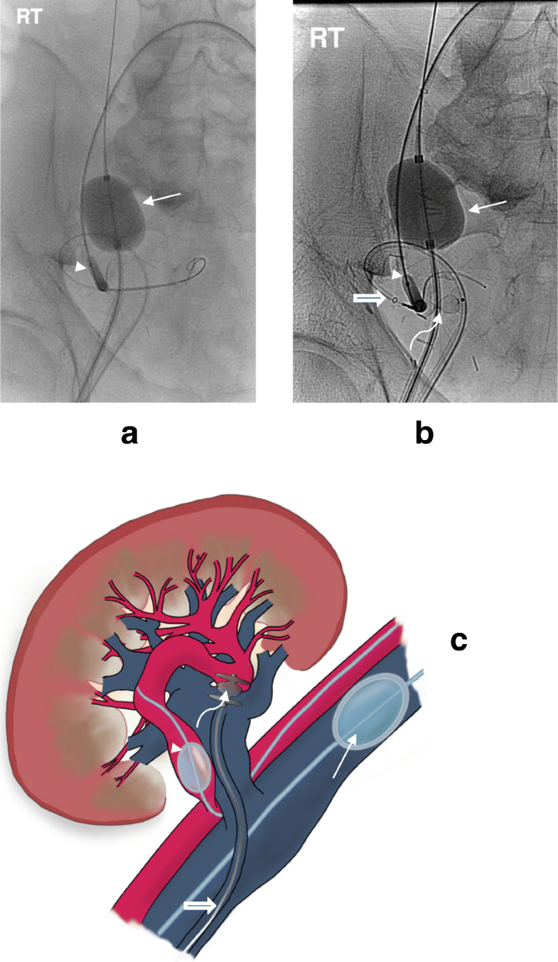 Dualballoon assisted superselective embolisation of high flow