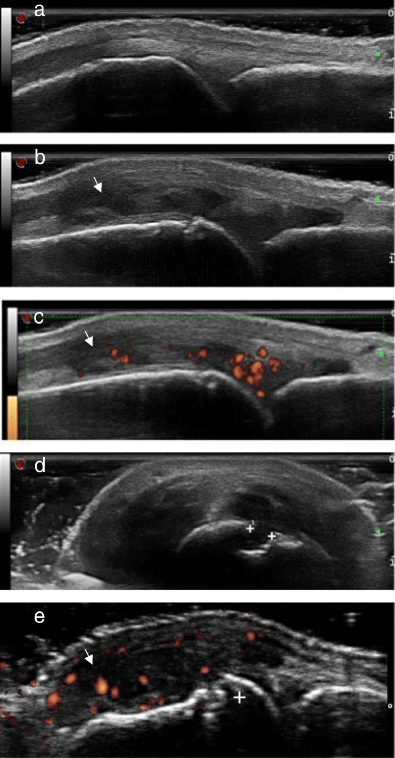 Ultrasound and its clinical use in rheumatoid arthritis where do we