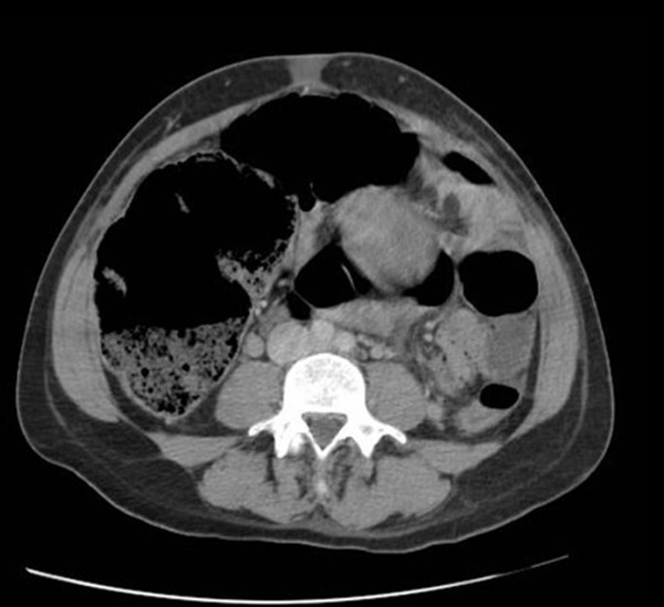 Ogilvie's syndrome with caecal perforation after Caesarean section a case report Journal of