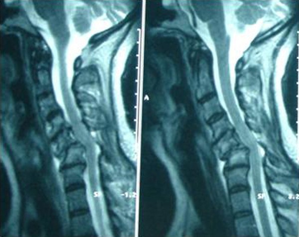 Misdiagnosed bilateral C5-C6 dislocation causing cervical spine