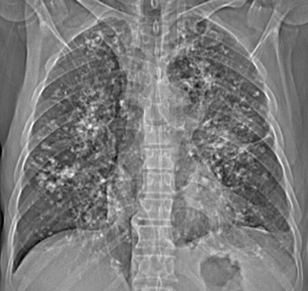 Pulmonary Amyloidosis With Calcified Nodules And Masses A Six Year