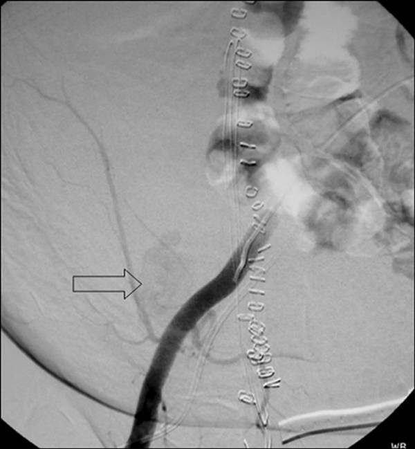 Coil embolization of inferior epigastric artery pseudoaneurysm after